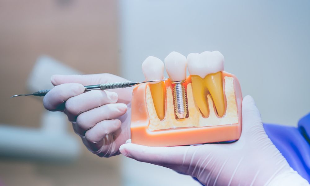 Dental Implants  and Implant supported dentures Image